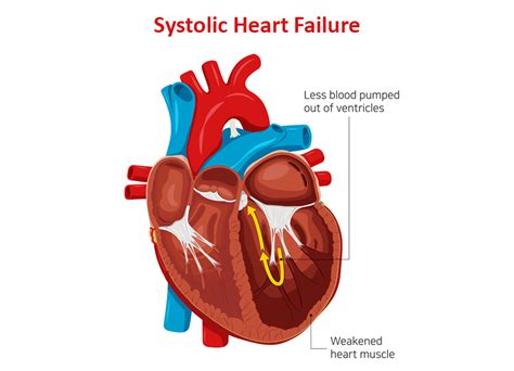 Systolic Heart Failure: Symptoms, Causes and Treatment